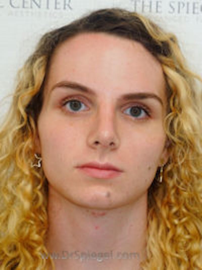 FFS Before & After Gallery - Patient 157140289 - Image 2