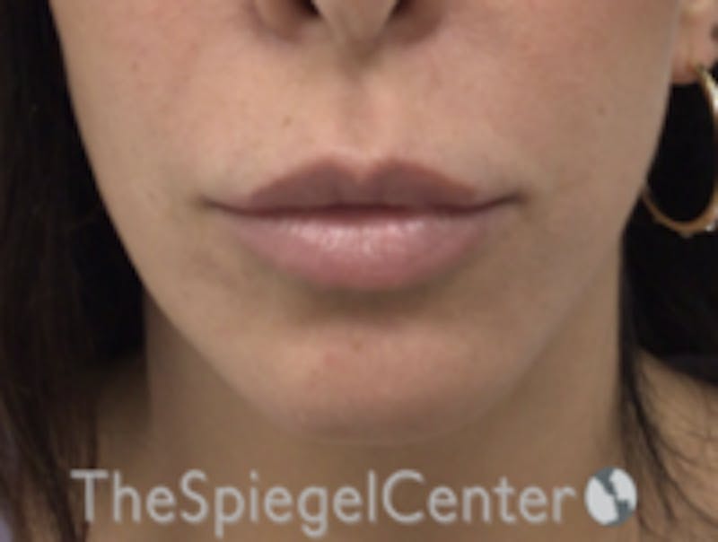 Chin Filler Before & After Gallery - Patient 157140295 - Image 1