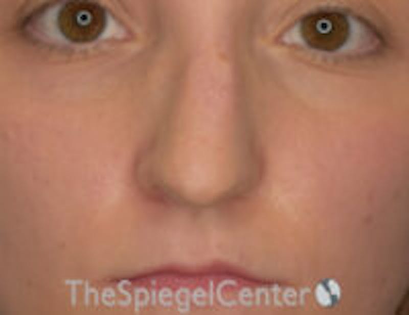 Rhinoplasty Before & After Gallery - Patient 157140299 - Image 3