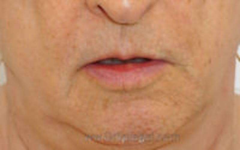 Lip Lift Before & After Gallery - Patient 157140294 - Image 1
