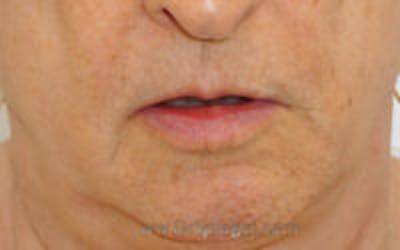 Lip Lift Before & After Gallery - Patient 157140294 - Image 1