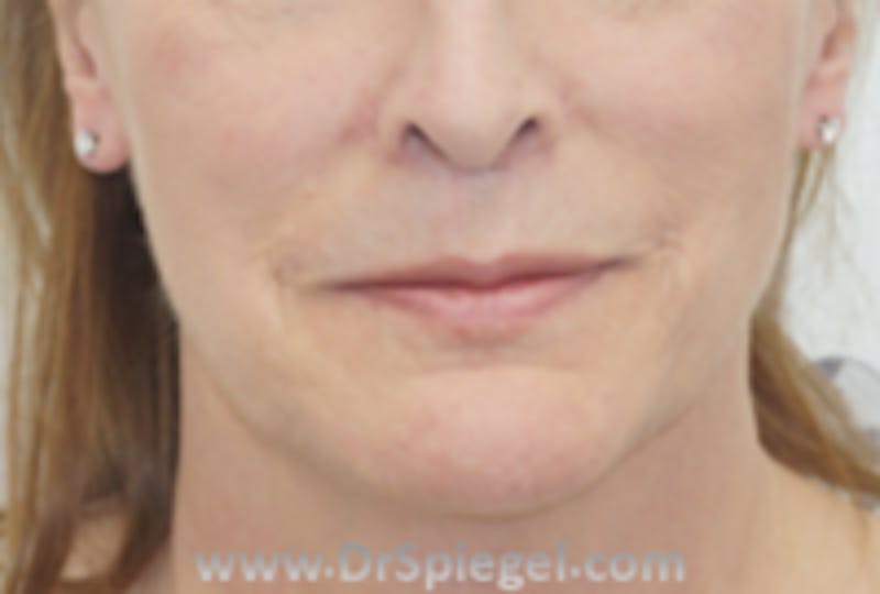 Mandible Contouring Before & After Gallery - Patient 157140293 - Image 2