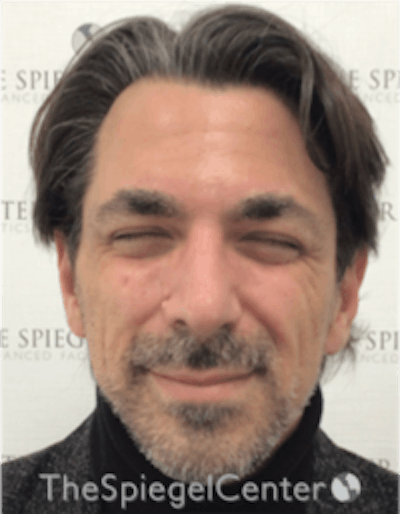 Botox / Dysport / Jeuveau / Xeomin Before & After Gallery - Patient 157140307 - Image 1