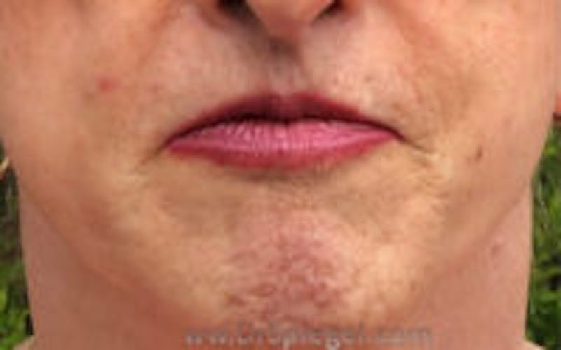 Lip Augmentation / Lip Implant / Lip Lift Before & After Gallery - Patient 157140294 - Image 2
