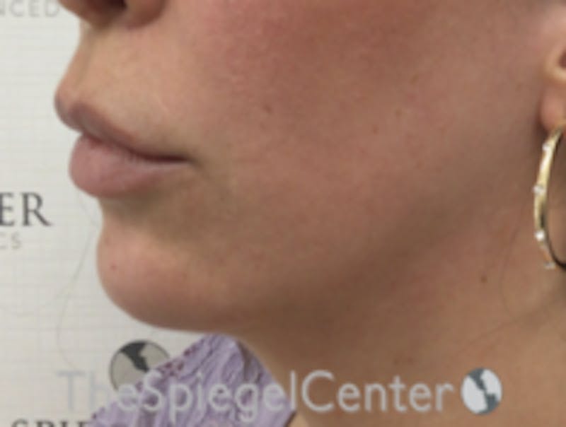 Chin Filler Before & After Gallery - Patient 157140295 - Image 4