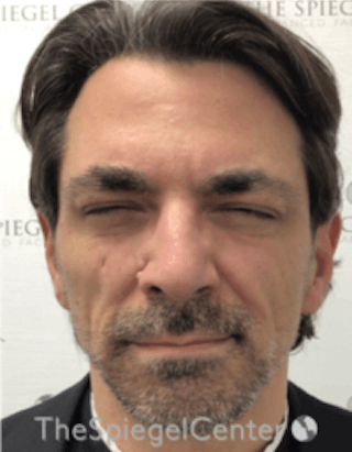 Botox / Dysport / Jeuveau / Xeomin Before & After Gallery - Patient 157140307 - Image 2