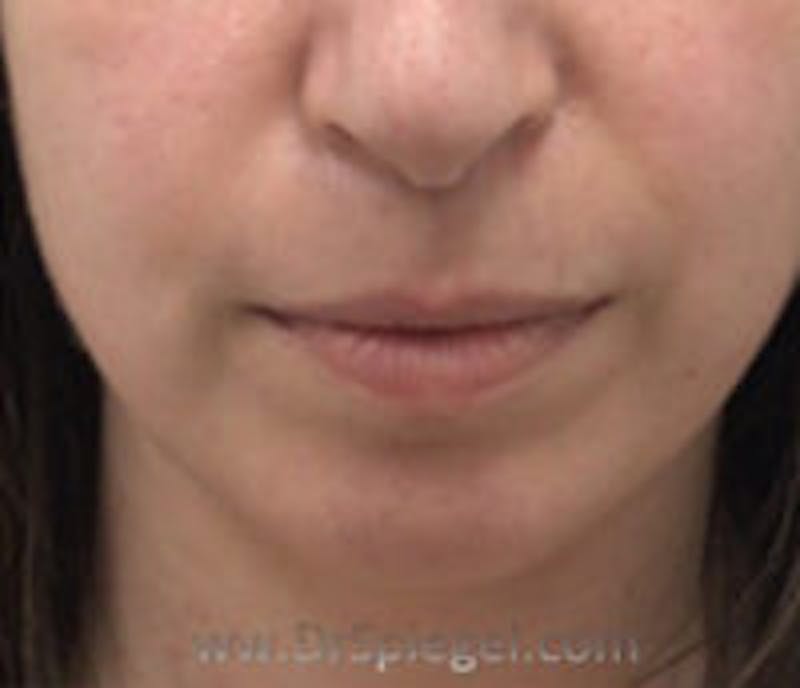 Chin Filler Before & After Gallery - Patient 157140308 - Image 1