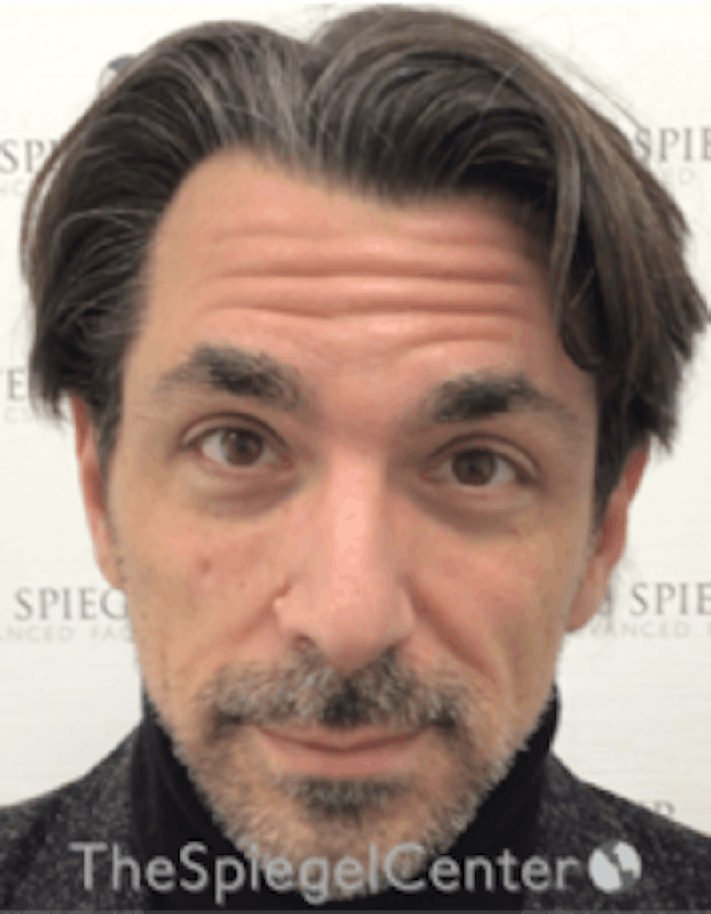 Botox / Dysport / Jeuveau / Xeomin Before & After Gallery - Patient 157140307 - Image 3