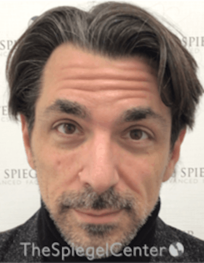 Botox / Dysport / Jeuveau / Xeomin Before & After Gallery - Patient 157140307 - Image 3
