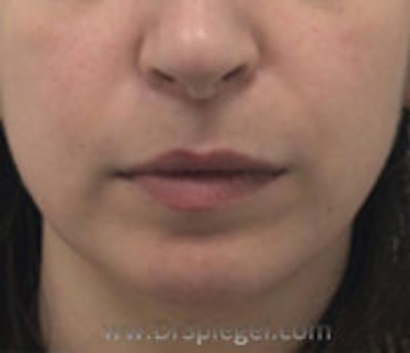 Chin Filler Before & After Gallery - Patient 157140308 - Image 2