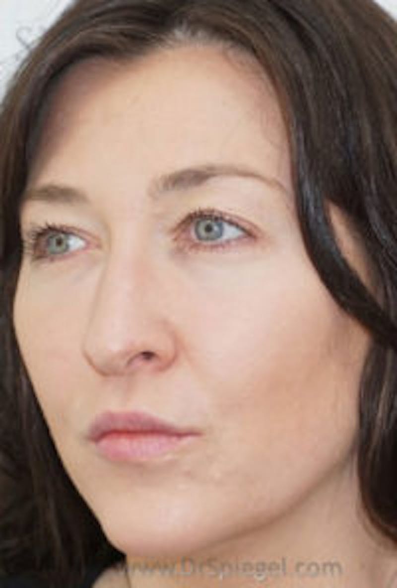 Liquid Face Lift Before & After Gallery - Patient 183935101 - Image 4