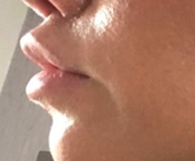 Lip Lift Before & After Gallery - Patient 157140306 - Image 2