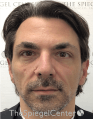 Botox / Dysport / Jeuveau / Xeomin Before & After Gallery - Patient 157140307 - Image 4