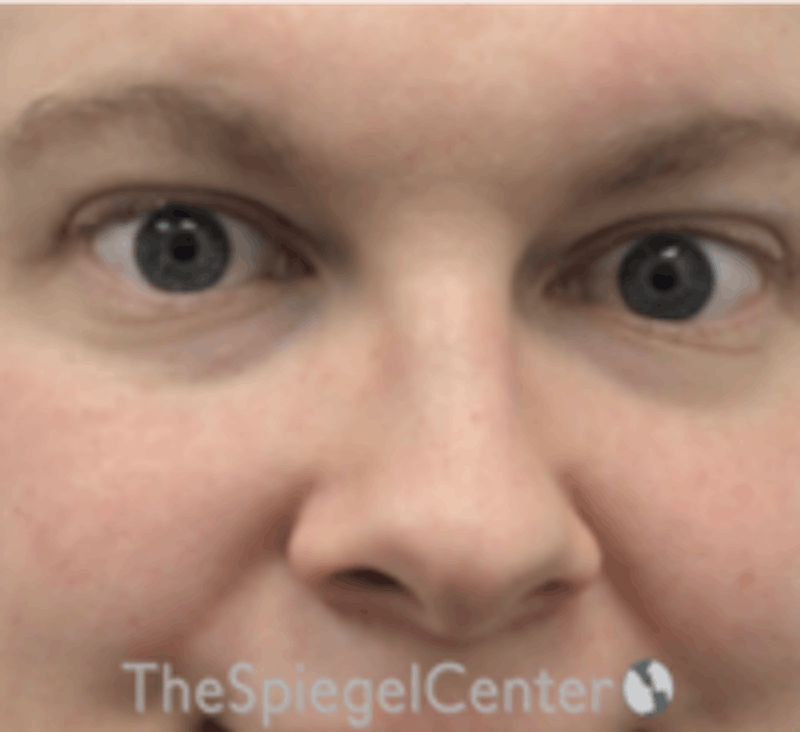 Rhinoplasty Before & After Gallery - Patient 157140315 - Image 3