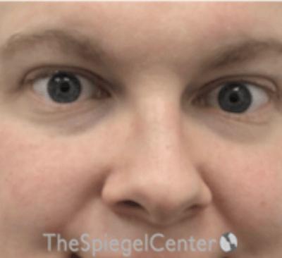 Rhinoplasty Before & After Gallery - Patient 157140315 - Image 3