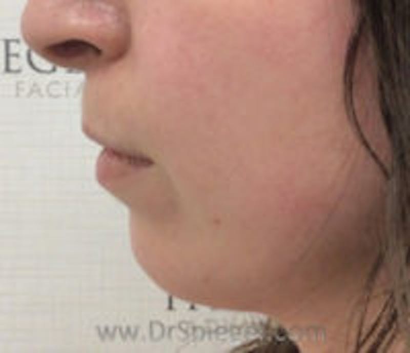 Chin Filler Before & After Gallery - Patient 157140308 - Image 3