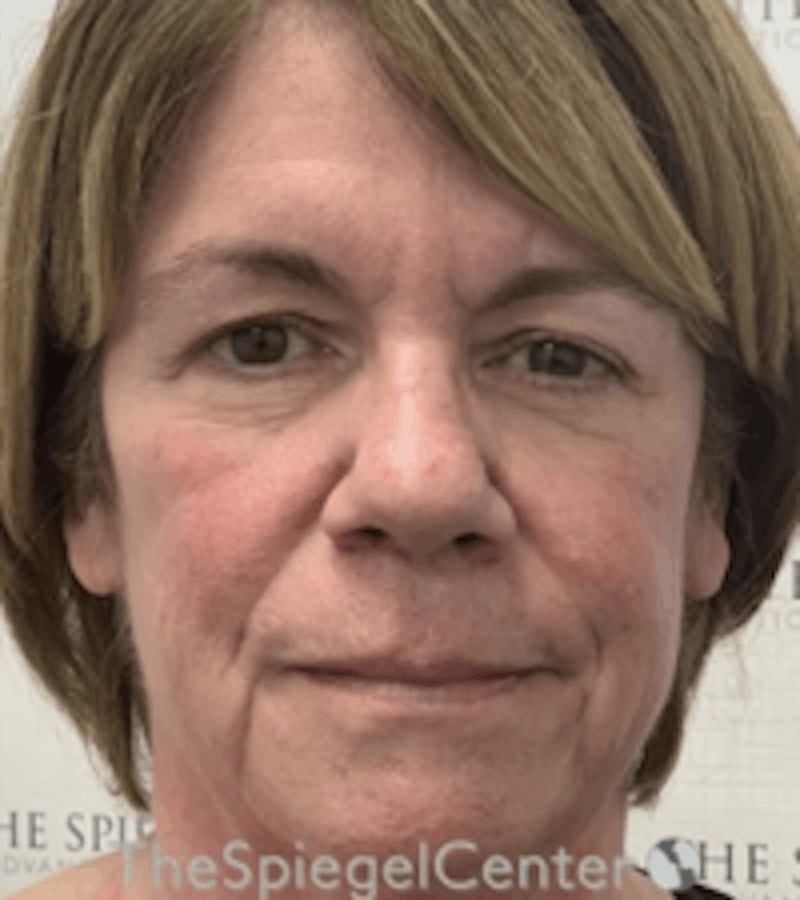 Liquid Face Lift Before & After Gallery - Patient 183935102 - Image 1