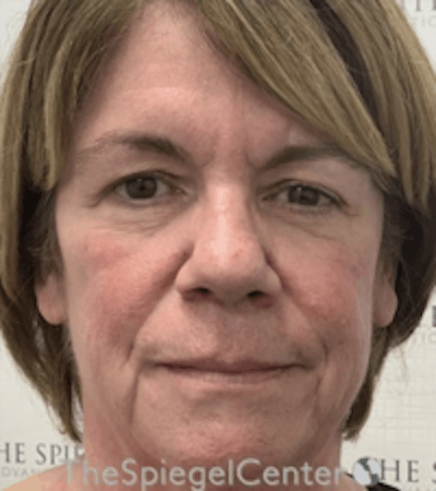 Liquid Face Lift Before & After Gallery - Patient 183935102 - Image 1