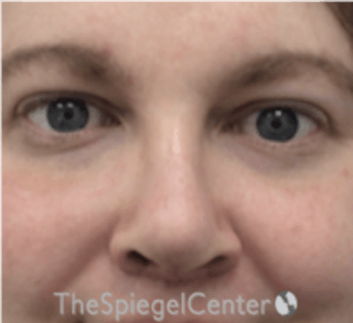 Rhinoplasty Before & After Gallery - Patient 157140315 - Image 4