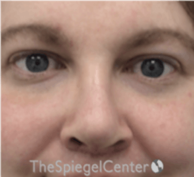 Rhinoplasty Before & After Gallery - Patient 157140315 - Image 4