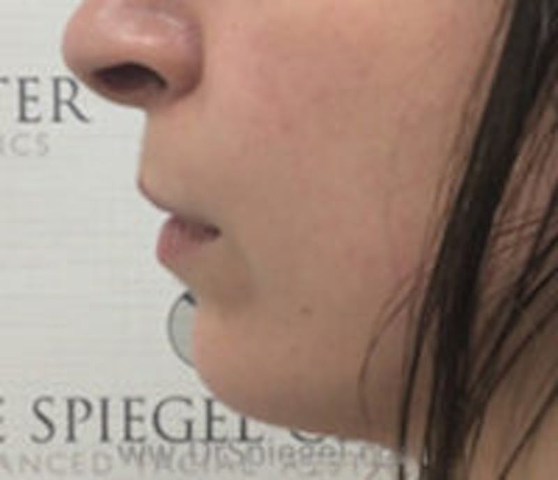 Chin Filler Before & After Gallery - Patient 157140308 - Image 4