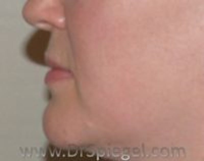 Lip Augmentation / Lip Implant / Lip Lift Before & After Gallery - Patient 157140312 - Image 1