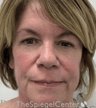 Liquid Face Lift Before & After Gallery - Patient 183935102 - Image 2