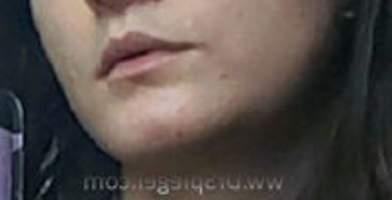 Mandible Contouring Before & After Gallery - Patient 157140309 - Image 2