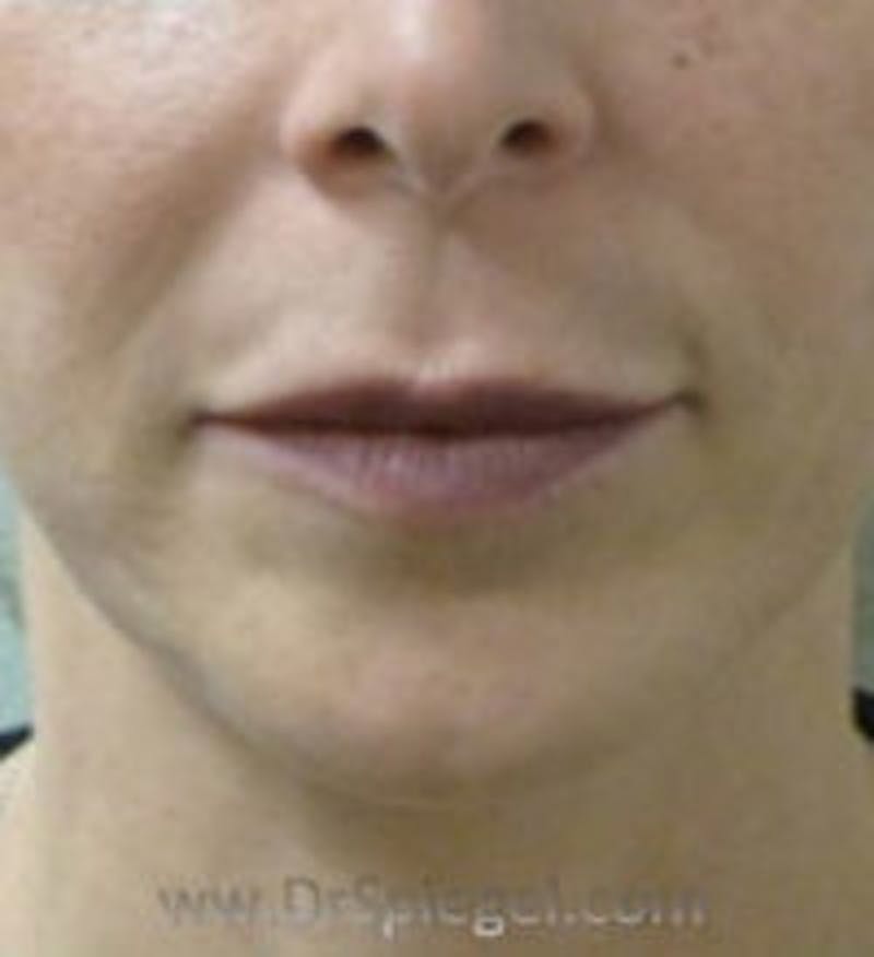 Chin Filler Before & After Gallery - Patient 157140323 - Image 1