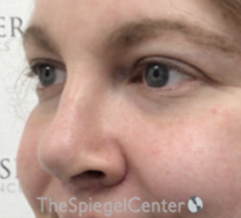 Rhinoplasty Before & After Gallery - Patient 157140315 - Image 2