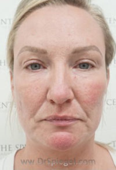 Facetite / Necktite / Embrace / Accutite Before & After Gallery - Patient 157140327 - Image 1
