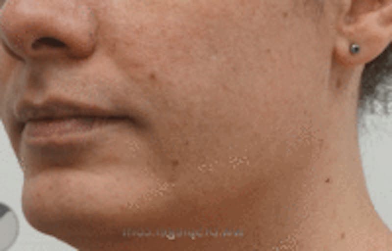 Mandible Contouring Before & After Gallery - Patient 157140318 - Image 1