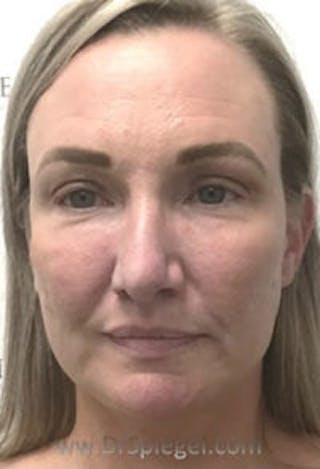 Facetite / Necktite / Embrace / Accutite Before & After Gallery - Patient 157140327 - Image 2