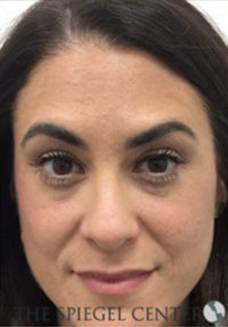 Botox / Dysport / Jeuveau / Xeomin Before & After Gallery - Patient 157140319 - Image 4