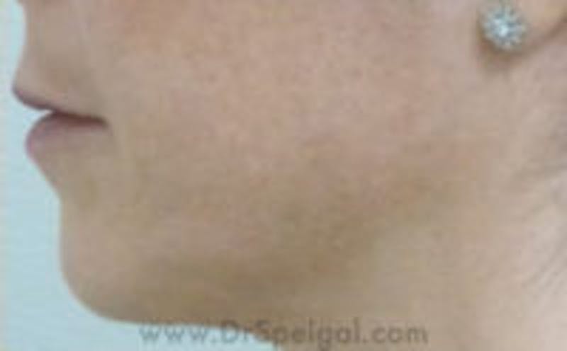 Chin Filler Before & After Gallery - Patient 157140323 - Image 3