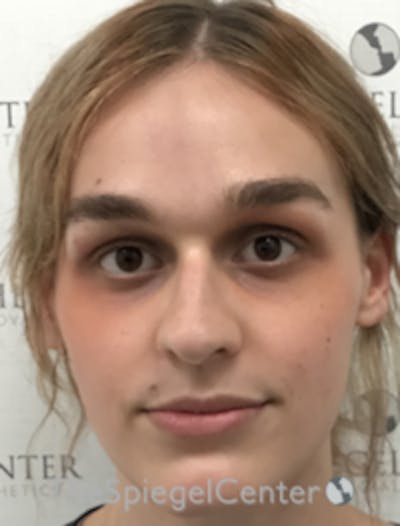 FFS Before & After Gallery - Patient 157140329 - Image 1