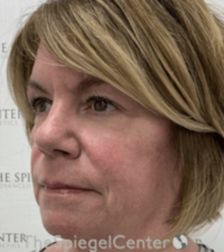 Liquid Face Lift Before & After Gallery - Patient 183935102 - Image 4