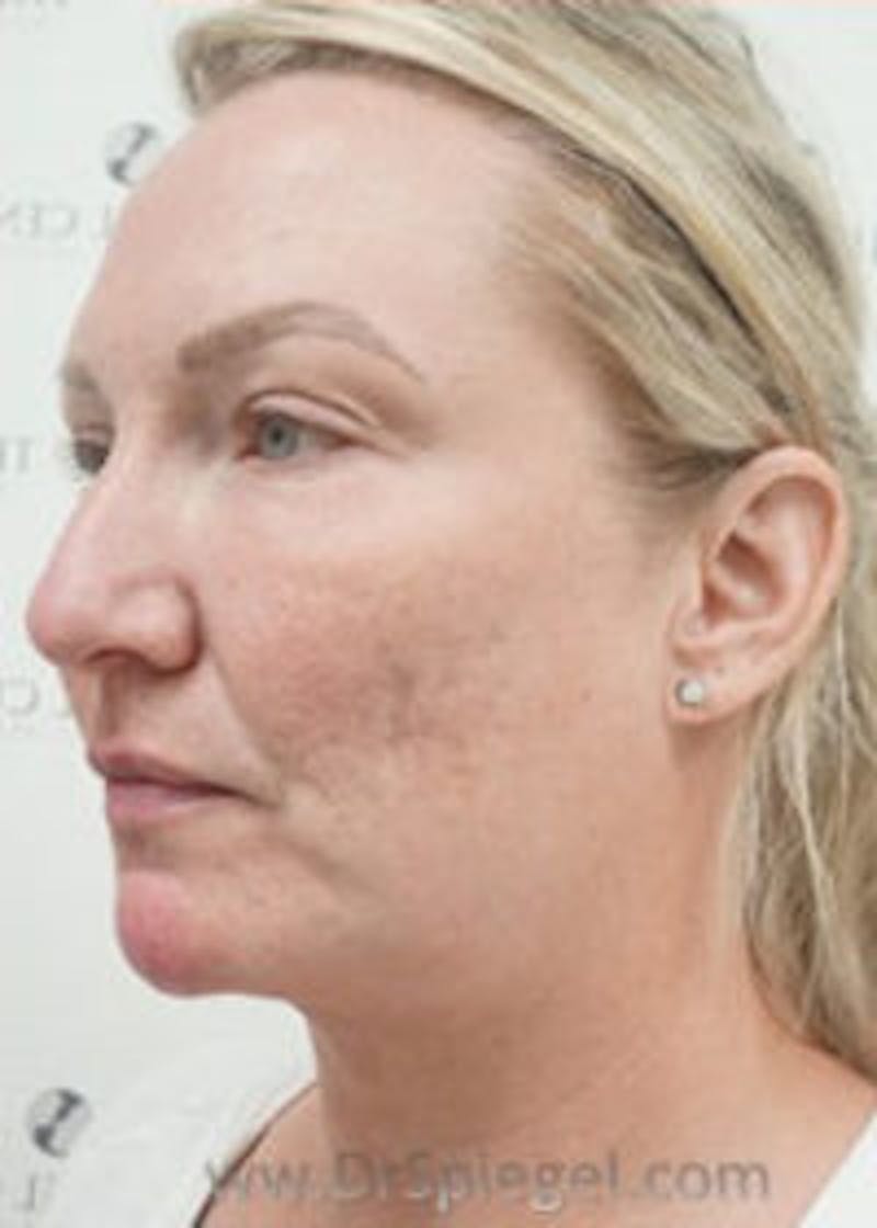 Facetite / Necktite / Embrace / Accutite Before & After Gallery - Patient 157140327 - Image 3