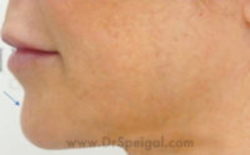 Chin Filler Before & After Gallery - Patient 157140323 - Image 4