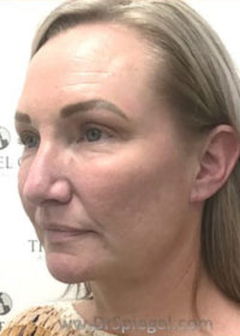 Facetite / Necktite / Embrace / Accutite Before & After Gallery - Patient 157140327 - Image 4