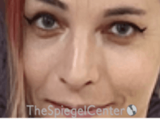 Rhinoplasty Before & After Gallery - Patient 157140328 - Image 4