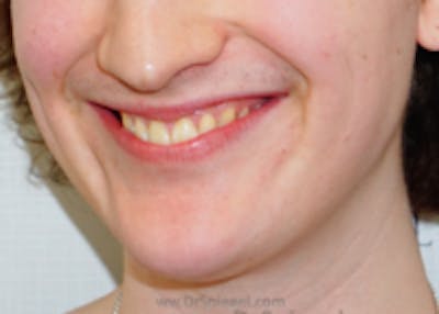 Mandible Contouring Before & After Gallery - Patient 157140326 - Image 1