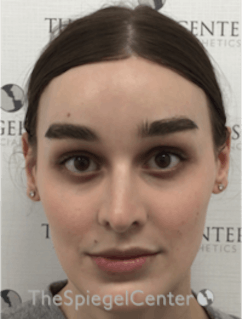 FFS Before & After Gallery - Patient 157140329 - Image 2