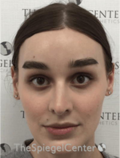 FFS Before & After Gallery - Patient 157140329 - Image 2