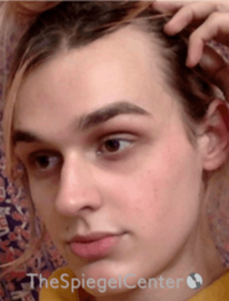 FFS Before & After Gallery - Patient 157140329 - Image 3