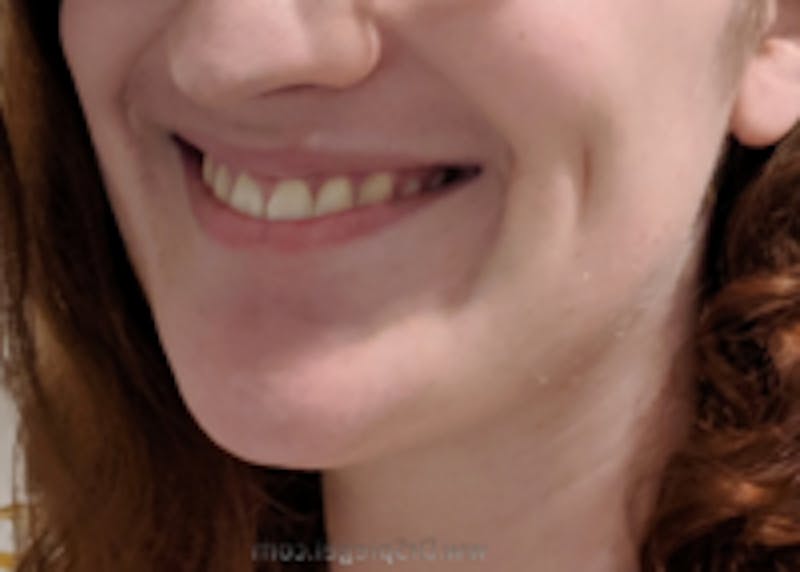 Mandible Contouring Before & After Gallery - Patient 157140326 - Image 2