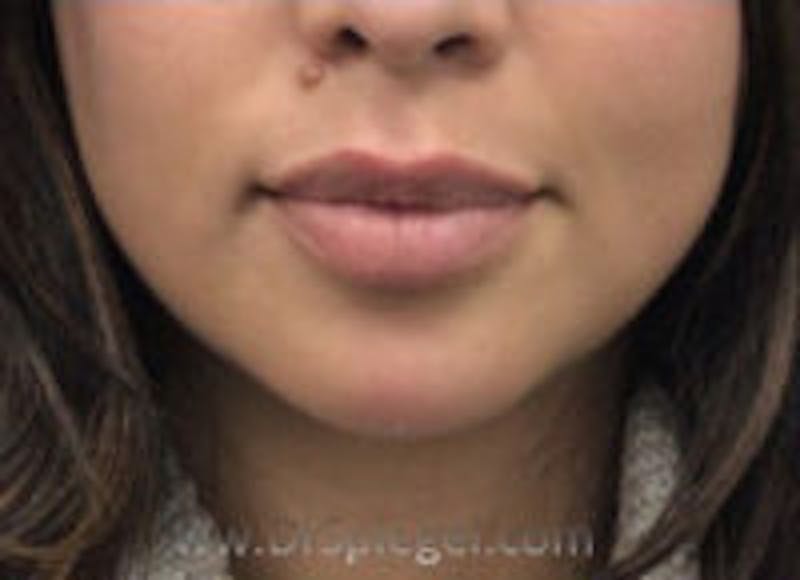 Chin Filler Before & After Gallery - Patient 157140334 - Image 2