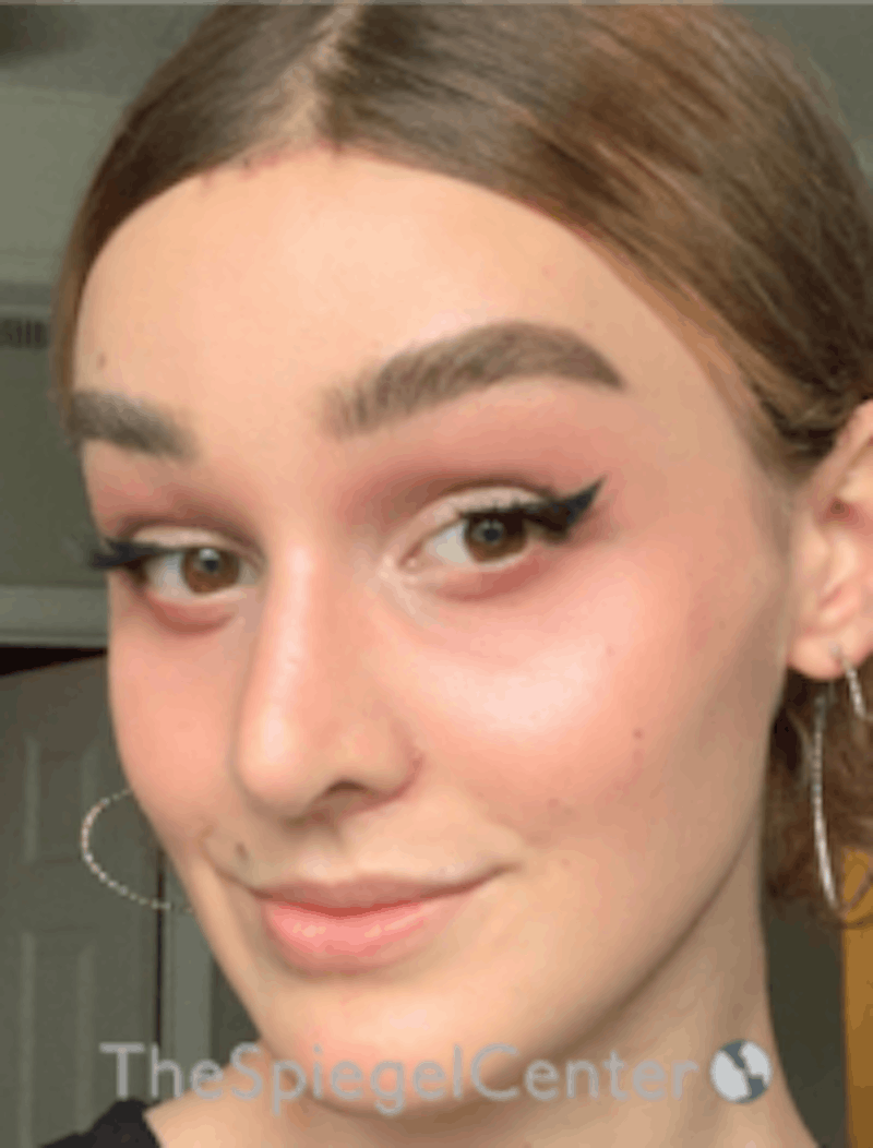 FFS Before & After Gallery - Patient 157140329 - Image 4