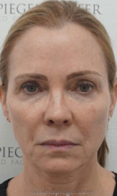 Facetite / Necktite / Embrace / Accutite Before & After Gallery - Patient 157140342 - Image 1