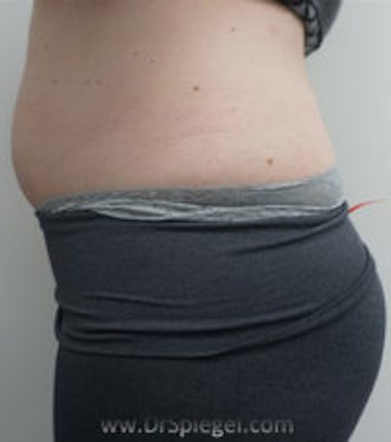 Fat Freezing Before & After Gallery - Patient 157140331 - Image 2